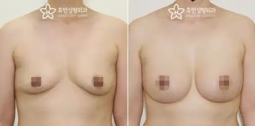 Mentor augmentation with subfascial placement at Human Plastic Surgery. Front view