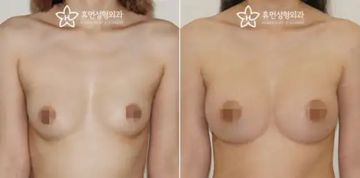 Motiva augmentation with different implant volumes at Human Plastic Surgery. Front view