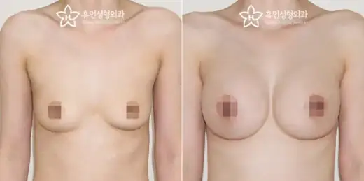 Motiva augmentation with dual-plane placement at Human Plastic Surgery. Front view