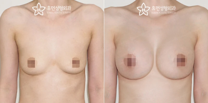Motiva augmentation with dual-plane placement at Human Plastic Surgery. Front view