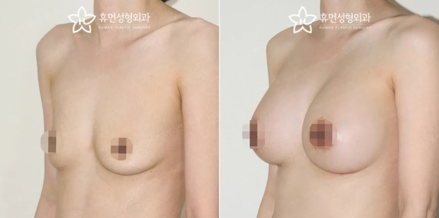 Motiva augmentation with dual-plane placement at Human Plastic Surgery. Oblique view