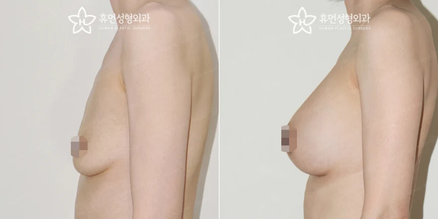 Motiva augmentation with dual-plane placement at Human Plastic Surgery. Side view