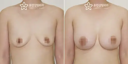 Motiva breast augmentation, 380 cc at Human Plastic Surgery. Front view