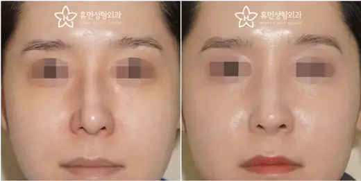Revision rhinoplasty with Gore-Tex removal at Human Plastic Surgery. Front view
