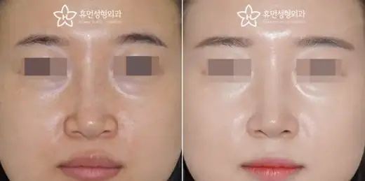 Revision rhinoplasty for a long and deviated nose at Human Plastic Surgery. Front view