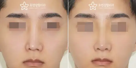 Revision rhinoplasty with rib cartilage at Human Plastic Surgery. Front view