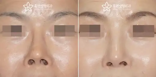 Revision rhinoplasty for a short nose at Human Plastic Surgery. Front view