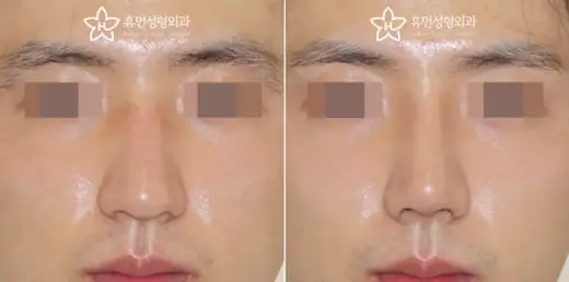 Rhinoplasty using the patient’s own cartilage at Human Plastic Surgery. Front view