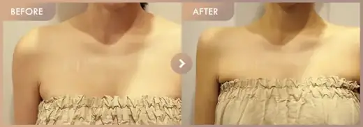 Shoulder filler before and after at Newstar Clinic