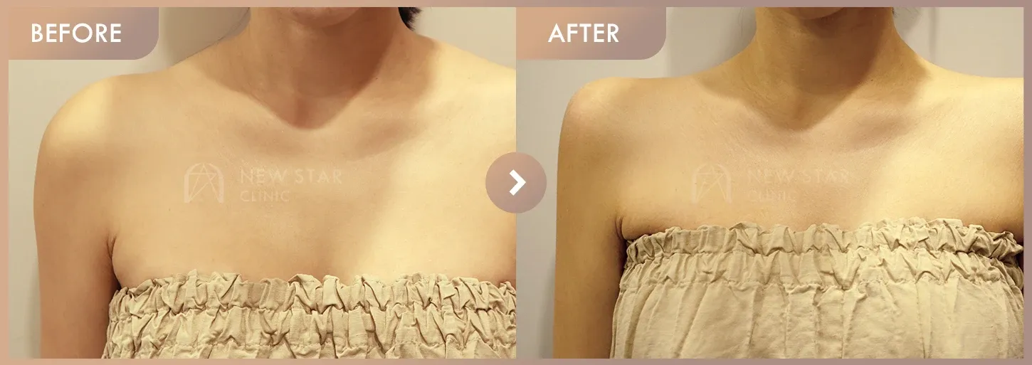 Shoulder filler before-and-after photos at Newstar Clinic