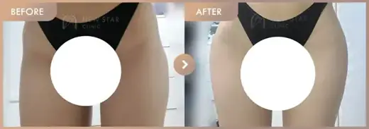 Body fillers before and after at Newstar Clinic