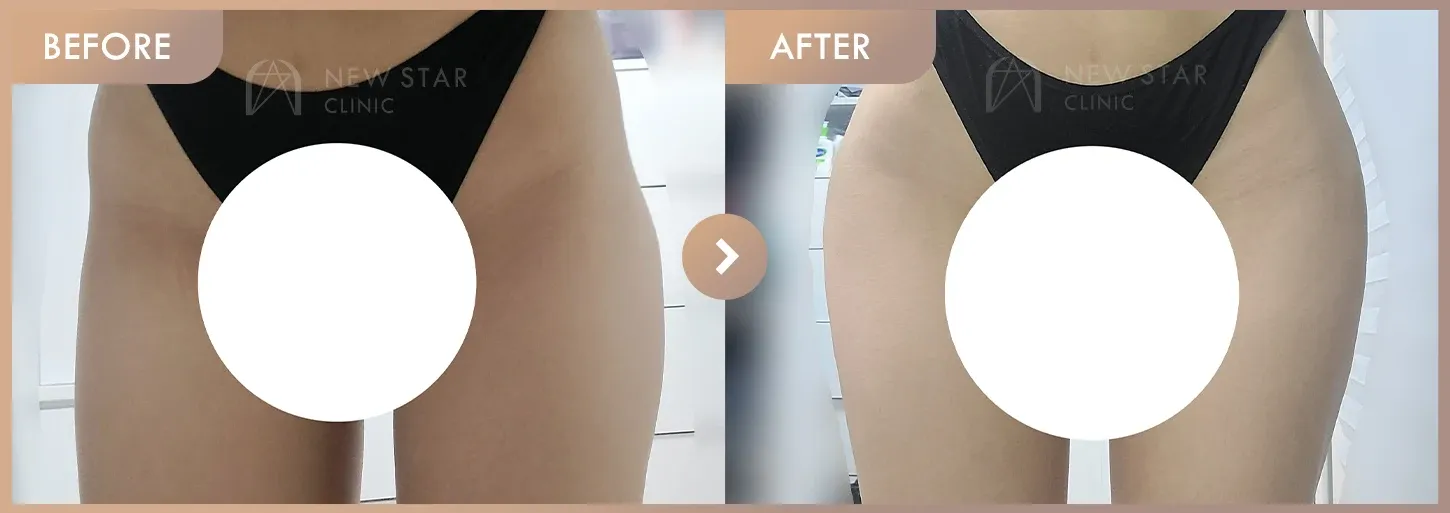 Body fillers before-and-after photos at Newstar Clinic