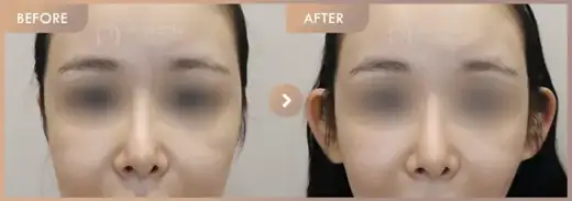 Body fillers before and after at Newstar Clinic