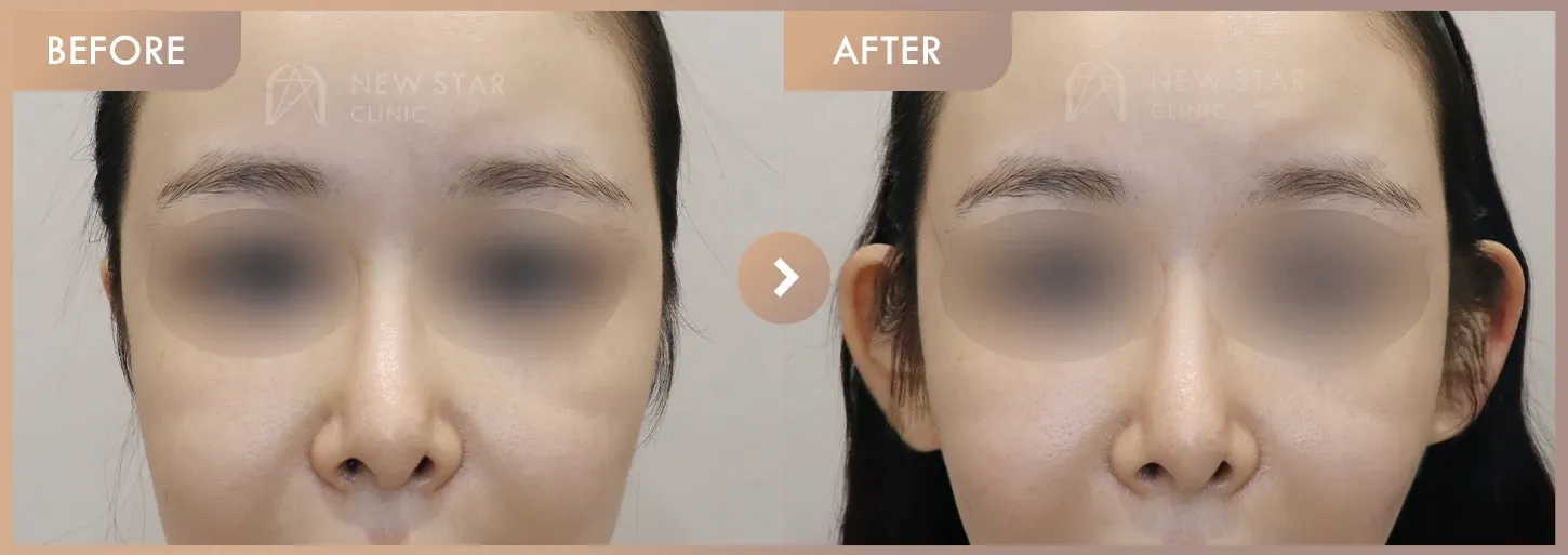 Body fillers before-and-after photos at Newstar Clinic