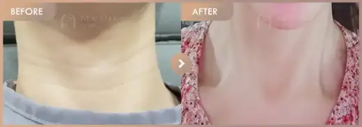 Body fillers before and after at Newstar Clinic