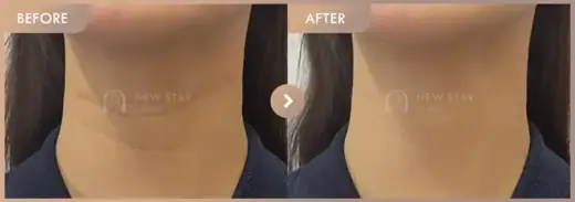 Body fillers: before-and-after comparison at Newstar Clinic