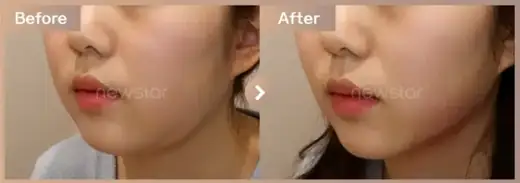 InMode FX: before-and-after comparison at Newstar Clinic