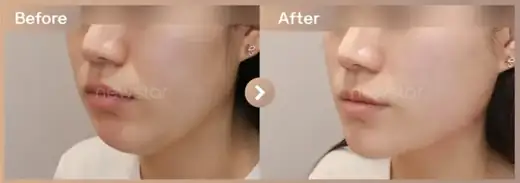 InMode FX + FORMA full-face before and after at Newstar Clinic