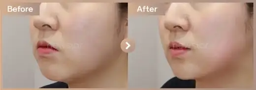 InMode FX + FORMA full-face before and after at Newstar Clinic