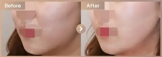 InMode full face + Titanium lifting before and after at Newstar Clinic