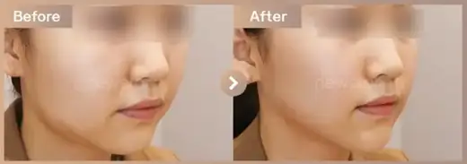 InMode FX + Oligio · 45-degree view: before-and-after comparison at Newstar Clinic