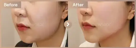 InMode FX + FORMA full-face + Oligio: before-and-after comparison at Newstar Clinic