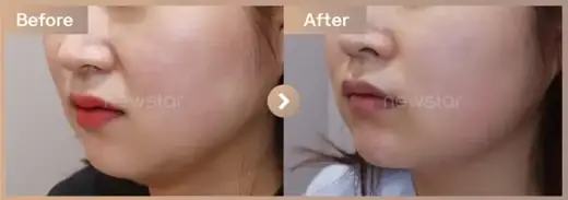 InMode FX + FORMA full-face: before-and-after comparison at Newstar Clinic