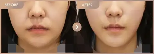 InMode FX + FORMA full-face + Oligio: before-and-after comparison at Newstar Clinic