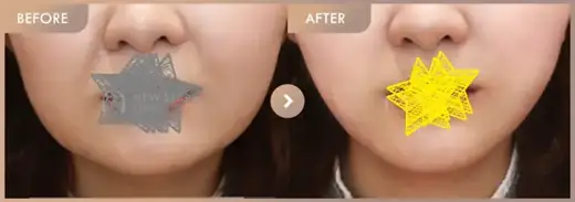InMode FX-full-face · Front view: before-and-after comparison at Newstar Clinic