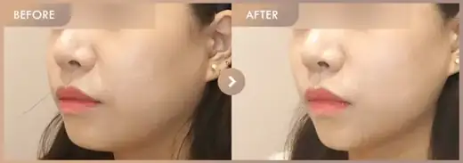 ONDA lifting: before-and-after comparison at Newstar Clinic