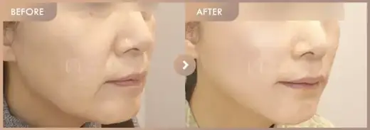 Nasolabial folds + Marionette lines Thread lifting,Filler: before-and-after comparison at Newstar Clinic