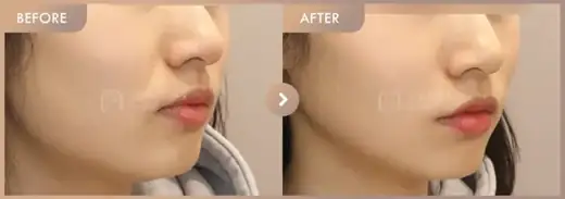 ONDA + Ultherapy: before-and-after comparison at Newstar Clinic