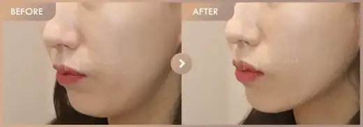 Chin filler + ONDA + New contouring injection: before-and-after comparison at Newstar Clinic