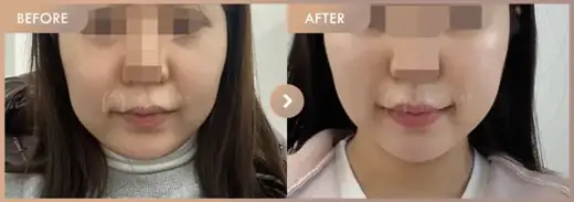 ONDA lifting: before-and-after comparison at Newstar Clinic