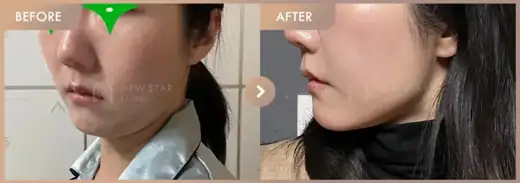 ONDA lifting: before-and-after comparison at Newstar Clinic
