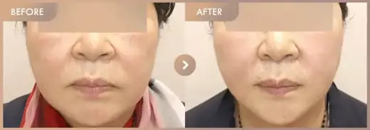 Ultherapy 500 + Titanium + ONDA: before-and-after comparison at Newstar Clinic