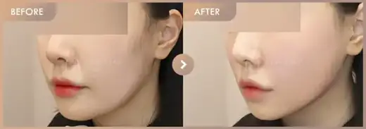 ONDA + Titanium: before-and-after comparison at Newstar Clinic