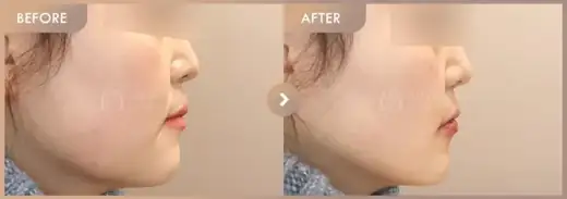 ONDA + Ultherapy 300: before-and-after comparison at Newstar Clinic