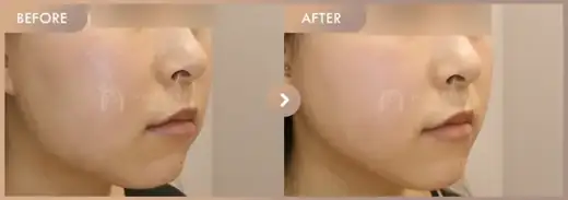 ONDA + New contouring injection: before-and-after comparison at Newstar Clinic