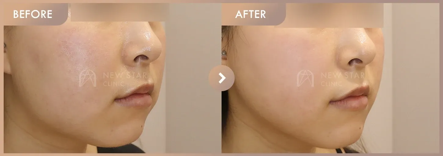 ONDA + New contouring injection before-and-after photos at Newstar Clinic