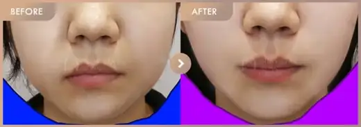 InMode FX-full-face: before-and-after comparison at Newstar Clinic