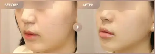 Ultherapy 300 + ONDA + Titanium: before-and-after comparison at Newstar Clinic