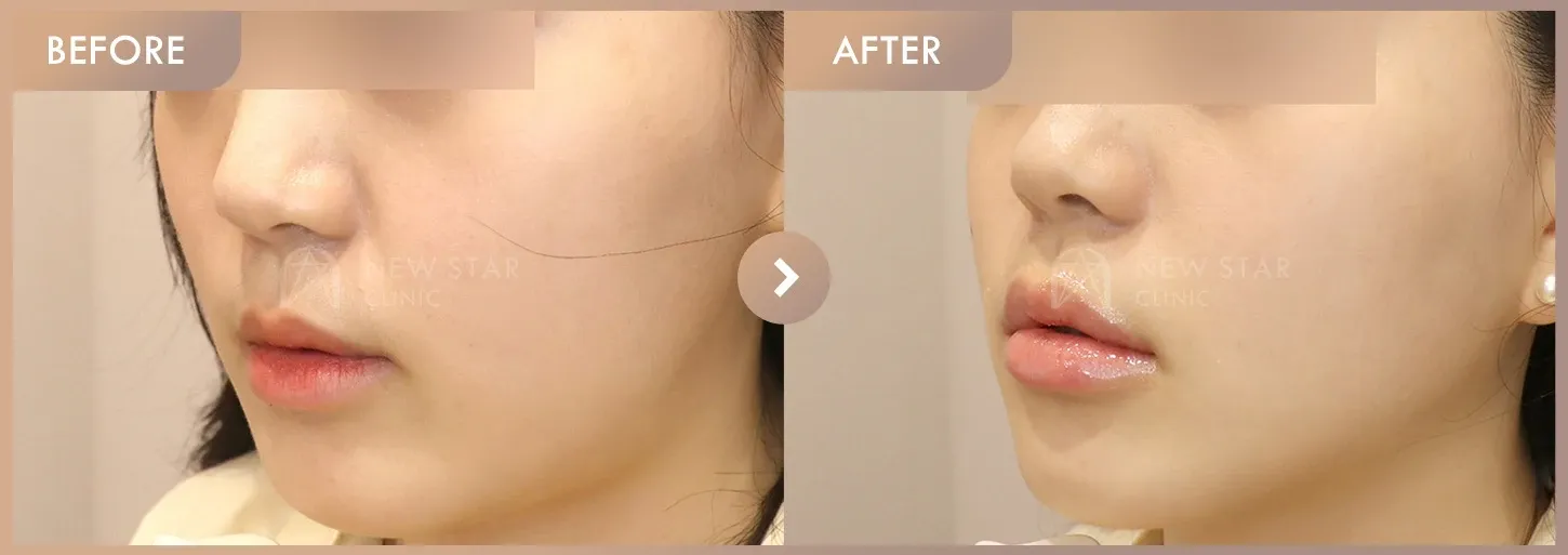 Ultherapy 300 + ONDA + Titanium before-and-after photos at Newstar Clinic