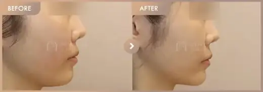 ONDA + New contouring injection: before-and-after comparison at Newstar Clinic