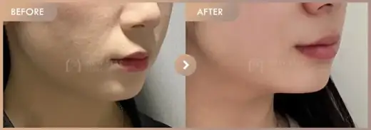 ONDA lifting: before-and-after comparison at Newstar Clinic