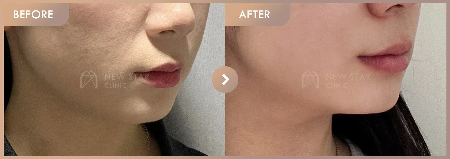 ONDA lifting before-and-after photos at Newstar Clinic