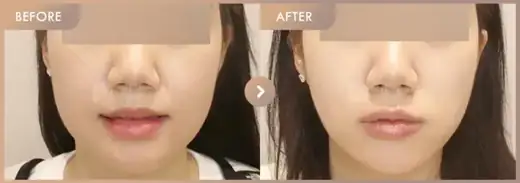 ONDA + Ultherapy 500 + New contouring injection: before-and-after comparison at Newstar Clinic
