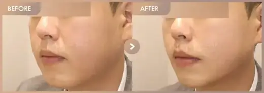 ONDA + New contouring injection: before-and-after comparison at Newstar Clinic