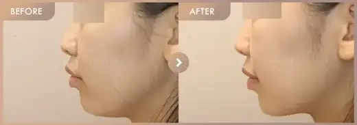 ONDA lifting: before-and-after comparison at Newstar Clinic