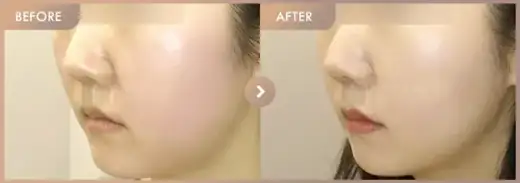 ONDA + Ultherapy 500 + New contouring injection: before-and-after comparison at Newstar Clinic